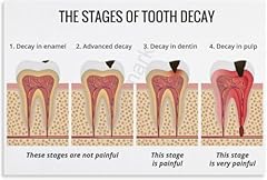 Tooth decay stages for sale  Delivered anywhere in USA 
