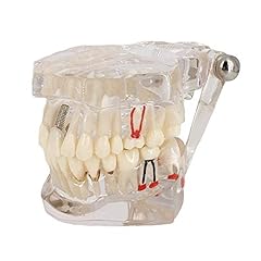 Modello denti malattia usato  Spedito ovunque in Italia 
