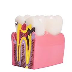 Annwah dental caries for sale  Delivered anywhere in USA 