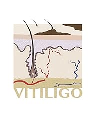 Vitiligo step step d'occasion  Livré partout en France