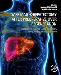 Safe major hepatectomy for sale  Delivered anywhere in USA 