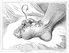 Gout, 1799. /N'The Gout.' Etching, 1799, By James Gillray. for sale  Delivered anywhere in UK