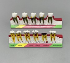 Modelo de ensino dental periodontal+doença cárie sortida dentes dentoforma tipodont comprar usado  Enviando para Brazil