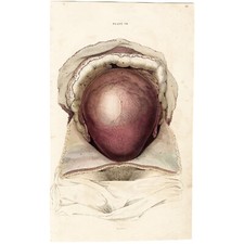 OBRA-PRIMA 1822 JOHN LIZARS Gravura Folio Colorida à Mão PL VII, ÚTERO GRAVÍDICO, usado comprar usado  Enviando para Brazil
