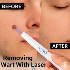 Maquina Laser Lapiz Removedor Dispositivo Eliminar Verrugas sin dolor sin agujas comprar usado  Enviando para Brazil