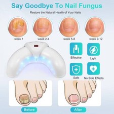 Nagelpilz aser gerät gebraucht kaufen  Versand nach Germany