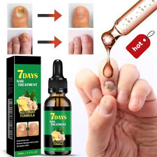 Ginger nail treatment for sale  UK