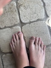 Toe nail for sale  GAINSBOROUGH