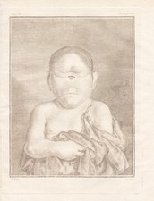 Medicina Cyclopia Zyklopie Deformidades Físicas Grabado En Cobre Buffon 1780 comprar usado  Enviando para Brazil