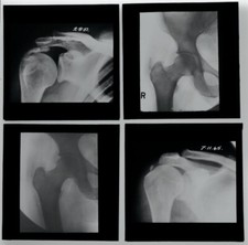 Lantern slides orthopaedic usato  Spedire a Italy