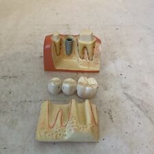 Dental implant bridge for sale  Rancho Cucamonga