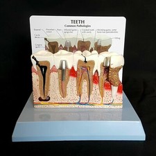 Modelo anatómico de dientes y encías enfermos - higiene dental anatomía médica dental CE segunda mano  Embacar hacia Mexico