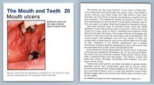 Mouth ulcers mouth for sale  SLEAFORD