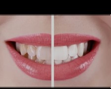 Sbiancamento denti con usato  Italia