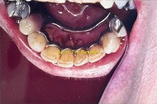 VINTAGE DENTES INFERIORES RESTAURAÇÕES PONTES COROA TRABALHO CLÍNICO DENTAL 35MM SLIDE, usado comprar usado VINTAGE DENTES INFERIORES RESTAURAÇÕES PONTES COROA TRABALHO CLÍNICO DENTAL 35MM SLIDE, usado comprar usado  Enviando para Brazil