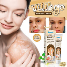 20g vitiligo remove d'occasion  France