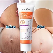 Stretch marks removal for sale  UK