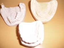 Gebissabdruck zahnabdruck gips gebraucht kaufen Gebissabdruck zahnabdruck gips gebraucht kaufen  Seesen