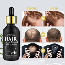 Minoxidil biotin 60ml for sale  CREWE