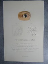 Epithélioma perlé iris d'occasion  Vernaison