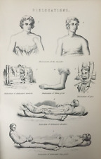 Dislocaciones médicas de hombro de la década de 1870 con dislocaciones de impresión antigua, usado segunda mano  Embacar hacia Argentina