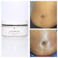 Stretch mark remover for sale  LONDON