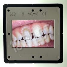 Exame odontológico 35mm corrediça - close-up de dentes superiores com coroas temporárias, usado comprar usado  Enviando para Brazil