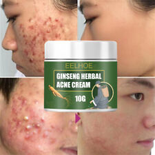 Effective acne removal for sale  Shipping to Ireland