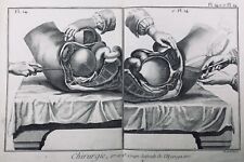 Ginecólogo IN 1779 Obstetricia Quirúrgica Grabado Medicina Enciclopedia Diderot segunda mano  Embacar hacia Argentina