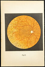 1896 lithographie ophtalmologi d'occasion  Besançon
