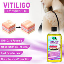 Vitiligo leukoplakia treatment for sale  Shipping to Ireland