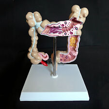 Anatomical Human Colon Pathological Diseases Model - Medical Anatomy, used for sale  Shipping to South Africa