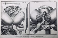 Usado, Ginecologia IN 1779 Obstetrícia Períneo Gravura Medicina Enciclopédie Diderot comprar usado  Enviando para Brazil