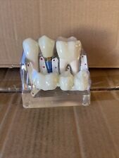 Exibição de implante dentário demonstração modelo dental análise ponte coroa comprar usado  Enviando para Brazil