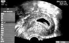 Ultraschall Baby Ultraschallbild personalisierbar Schwangerschaft Foto Bild comprar usado  Enviando para Brazil