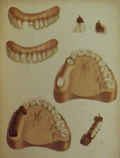 COROA, BARRA E PONTE-TRABALHO 1885 - Livro médico antigo de odontologia e dentes falsos comprar usado  Enviando para Brazil
