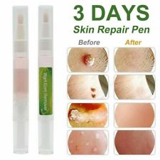 Skin tag removal for sale  ST. IVES